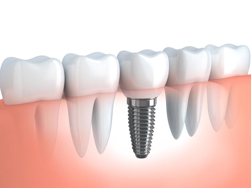 Dental Implants Pukalani, HI